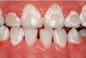 برای سفید کردن دندان ها با بریس ها چه گزینه هایی دارید؟