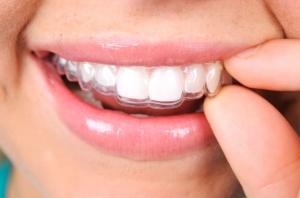 بریس های شفاف چگونه می توانند به جابجایی دندان ها کمک کنند؟