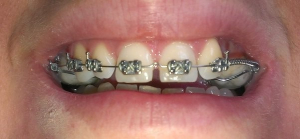 افزایش فاصله بین دندان ها با بریس ها