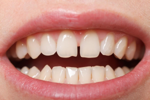 کمک به بستن فاصله بین دندان ها با بریس ها