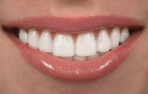 ارتودنسی دندان یا کامپوزیت دندان؛ کدام بهتر است؟