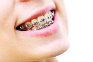 تاثیر نیروهای شدید وارد بر دندان در ارتودنسی سریع و کوتاه مدت چیست؟