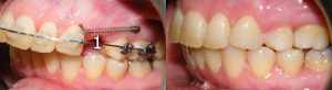 دندان های پرمولر و عملکرد آنها چیست؟