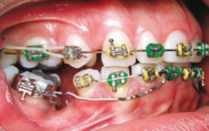 بعد از کشیدن دندان های پرمولر چه مراقبت های بعدی لازم هستند؟