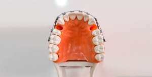 شرایط کشیده شدن دندان در طول درمان ارتودنسی