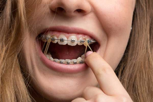 فرآیند درمان ارتودنسی برای ایرانیان مقیم سایر کشورها چگونه است؟