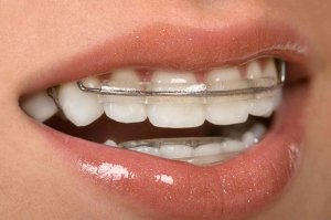 چه زمانی ناراحتی ناشی از نگهدارنده فلزی اهمیت دارد؟