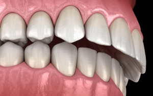 چه چیزی باعث اوربایت می شود؟