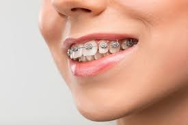 چگونه می توان از بروز اوربایت جلوگیری کرد؟