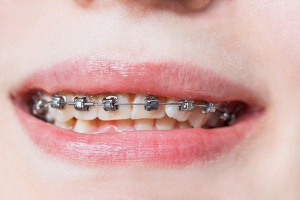 براکت های خود تنظیم شونده