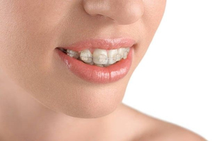 بریس های سرامیکی در مقایسه با بریس های خود تنظیم شونده