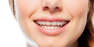 1.چرا ارتودنسی برای برخی اتباع پیچیده‌تر می‌شود؟