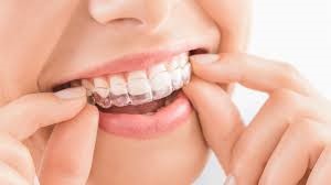مزایای انتخاب الاینرهای شفاف برای اصلاح اوربایت
