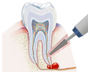عفونت دندان چگونه شکل میگیرد؟