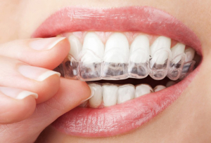 ارتودنسی نامرئی چیست و چگونه کار میکند؟