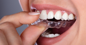 الاینر شفاف Clear aligner treatment