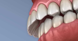 اوربایت Overbite
