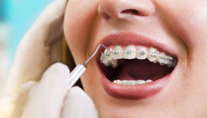 چه زمانی بلاگر باید به ارتودنتیست مراجعه کند؟