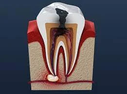 چرا جراحی کیست قبل از ارتودنسی اهمیت دارد؟