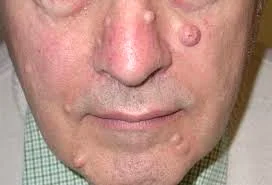 چرا ارتودنسی فلزی برای بیماران نوروفیبروما مناسب نیست؟