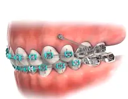 مینی اسکرو چیست؟