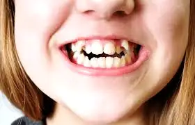 چطور می‌فهمیم لوزه سوم روی فک اثر گذاشته است؟