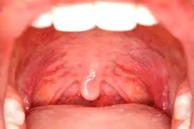 لوزه سوم چیست و چه نقشی دارد؟