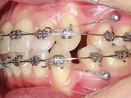 کاربردهای اصلی مینی اسکرو در ارتودنسی