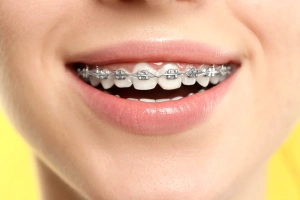 ارتودنسی اقساطی؛ فقط یک امتیاز مالی نیست