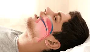 آپنه تنفسی خواب چیست؟