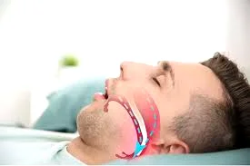 چه کسانی کاندید مناسب جراحی فک برای آپنه خواب هستند؟