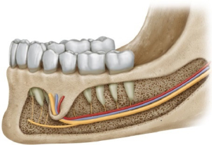 چرا جراحی دندان عقل می‌تواند به عصب آسیب بزند؟