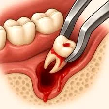آیا خونریزی بعد از کشیدن دندان طبیعی است؟