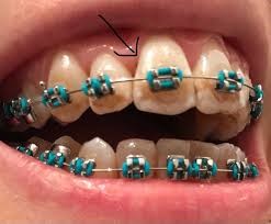 چه عواملی باعث پوسیدگی دندان ها با بریس ها می شوند؟