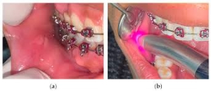 از لیزر می توان برای بهبود شکل و ظاهر لثه استفاده کرد.