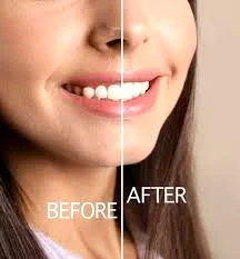 مزایای ترکیب ارتودنسی و لیفت لثه