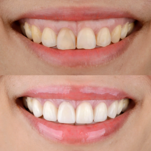 لبخند لثهای چیست و چه زمانی نیاز به لیفت لثه داریم؟