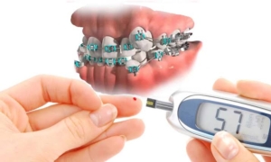 آیا افراد مبتلا به دیابت میتوانند ارتودنسی انجام دهند؟